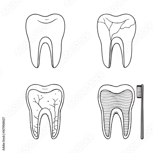Dental Health - Tooth Decay Stages