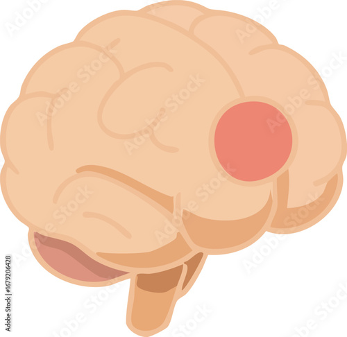 This illustration depicts a human brain with a highlighted red circular spot, symbolizing brain injury, stroke, or localized neurological damage.