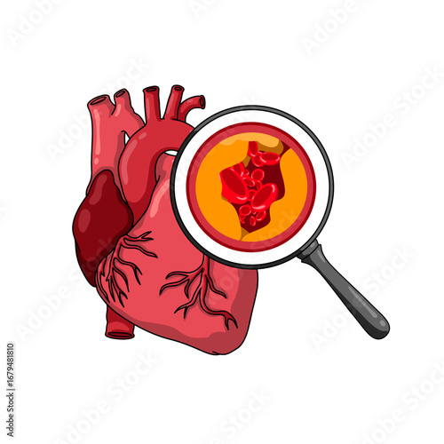 Cholesterol in human blood vessels. Fat in arteries veins. Blood vessels clogged by plaque. Medical poster illustration for clinic or lab, or for biology study.