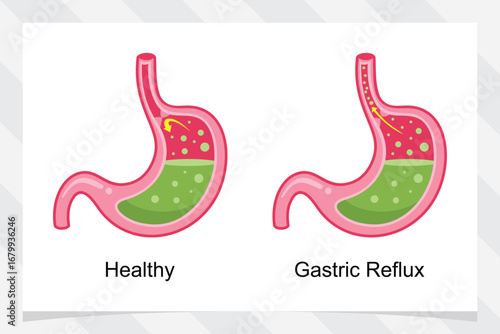 Gastric reflux (GERD) vector illustration. condition of stomach acid.
