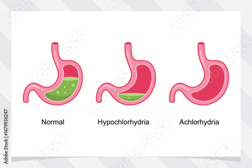 Hypochlorhydria Achlorhydria vector illustration. condition of stomach acid.
