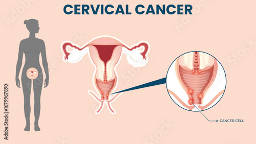Cervical Cancer Awareness Concept with Medical Illustration