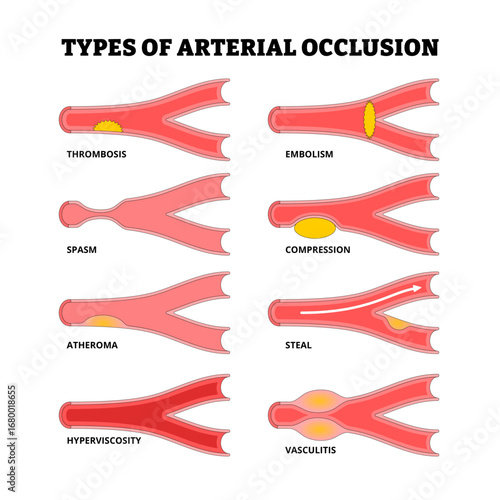 Different types of arterial occlusion types. Vascular disease. Artery obstruction. Healthcare poster. Labeled thrombosis, spasm, embolism, compression, atheroma, steal, hyperviscosity, vasculitis.