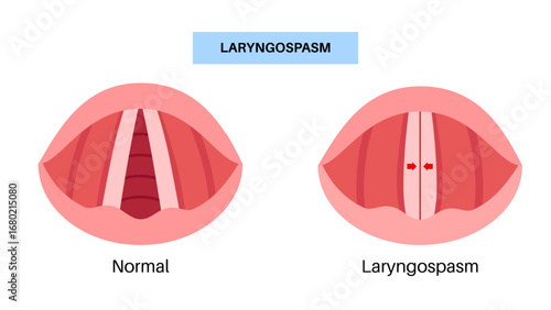 Laryngospasm medical poster