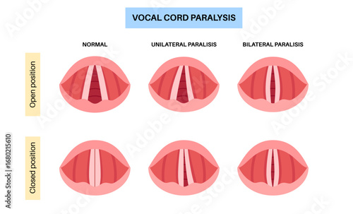 Vocal cords paralysis