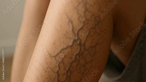 Pain legs artery. Varicose Veins Leg Close Up of Intricate Patterns and Textures, Highlighting Health and Beauty of Skin for Awareness and Curiosity