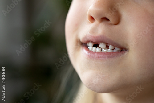A child with missing teeth smiles in close-up. Loss of baby teeth. Caring for children's teeth