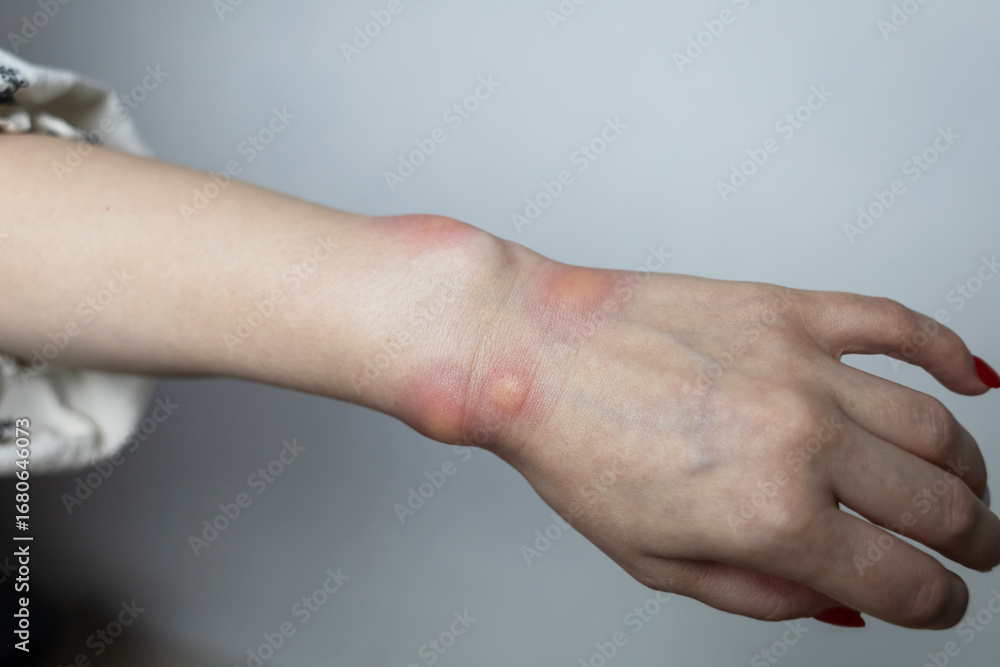 Fototapeta premium Close up of a swollen wrist with visible redness, inflammation, caused by an insect bite or allergic reaction. The hand signs of rash, itching, and local pain, typical of mosquito bites, bee stings