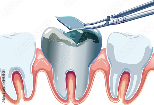 Visual guide to tooth decay and gum health with dental tool, ideal for teaching oral hygiene in a non-violent, educational format.

