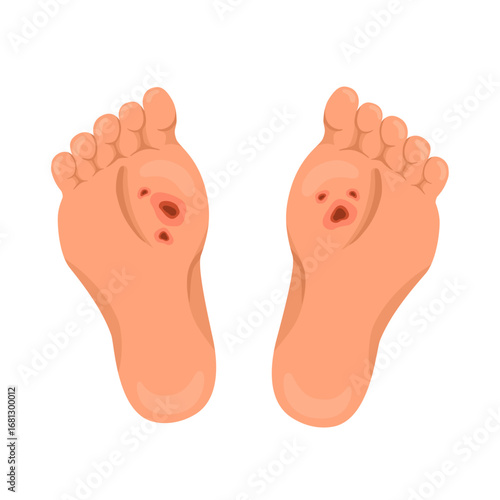 vector illustration of the sole of the foot affected by corn disease