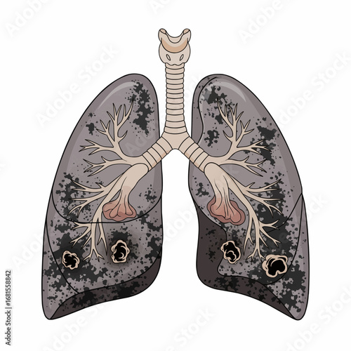 Illustration of Damaged Lungs Depicting Respiratory Health and Smoking Effects
