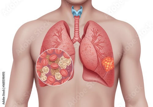 Medical illustration of human lungs with highlighted cancerous nodules.