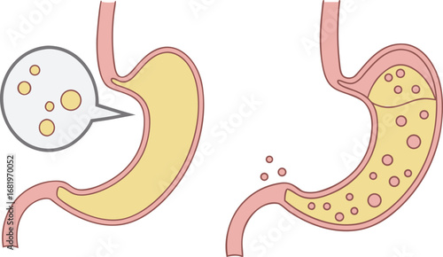 Diagram of a healthy vs. diseased human stomach showing digestion and potential issues