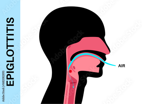 Epiglottitis medical poster