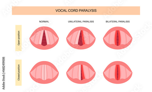 Vocal cords paralysis