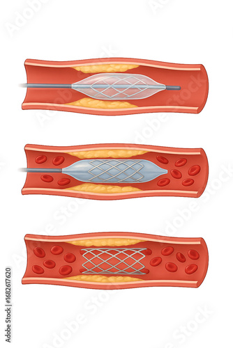 Detailed medical illustration showing the step-by-step process of stent placement in a partially blocked artery. The image demonstrates a balloon angioplasty with stent expansion and final positioning