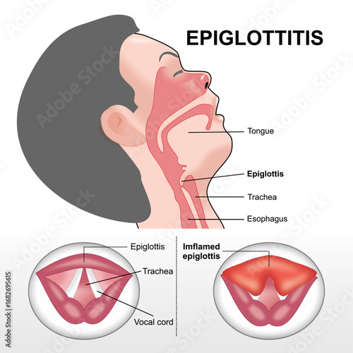 Inflamed Epiglottitis vocal cord flashcard illustration