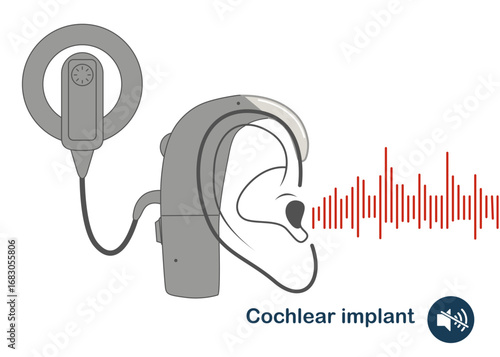 Cochlear implant device electrically stimulates nerve. Ear sound wave adults and children hard middle exam. World Deaf Day in last Sunday of September. Flat vector illustration