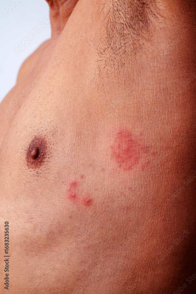Fototapeta premium a man with shingles on his chest