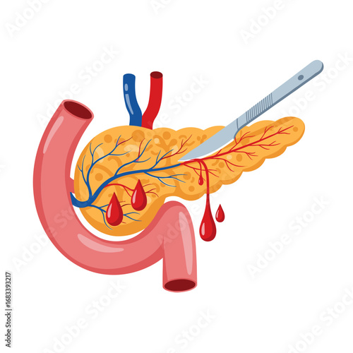 Illustrative depiction of pancreatic surgery demonstrating a surgical instrument and blood droplets