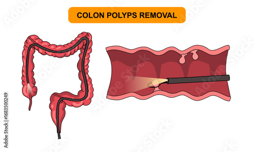 Illustration of polyp removal in the colon. Inflammatory and hamartomatous. Pain and inflammation in the human body. Illustration of internal organ examination. Vector for medical poster and science