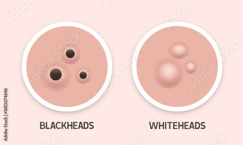 Blackheads and whiteheads illustration. Types of acne. Vector 3d illustration