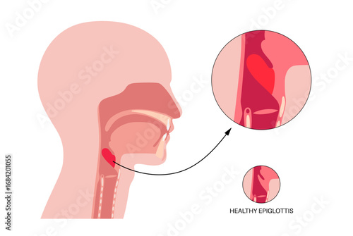 Epiglottitis medical poster