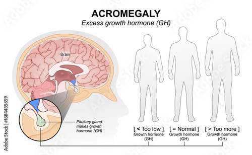 Excess growth hormone (GH) Acromegaly Flashcard Illustration