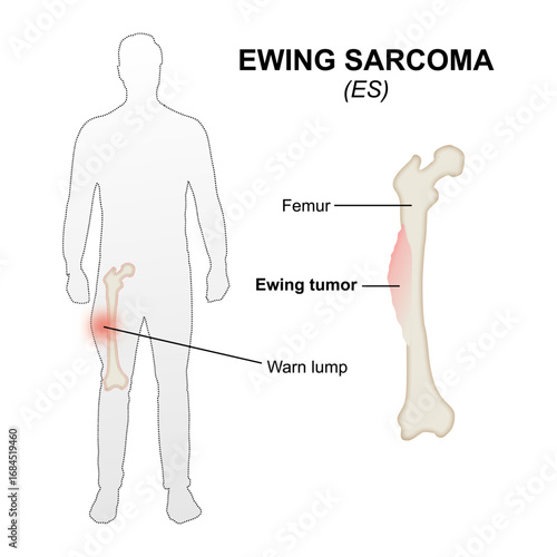 Ewing Sarcoma, ewing tumor flashcard medical illustration