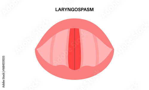 Laryngospasm medical poster