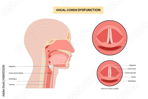 Vocal cords dysfunction