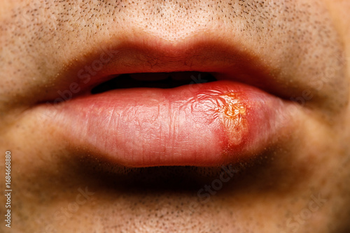 Fotografi Close-up of herpes on male lip with cold sore blister