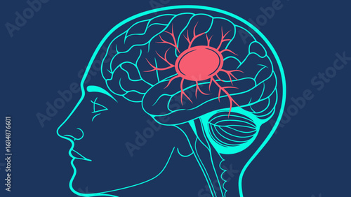 Stylized human brain with red aneurysm and blood vessels