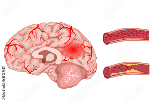 Cerebrovascular disease, stroke, brain, blood vessel blockage