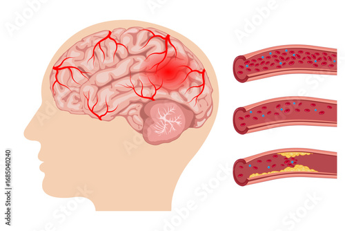 Brain damage, cerebrovascular disease, brain injury, stroke, blood flow disorder