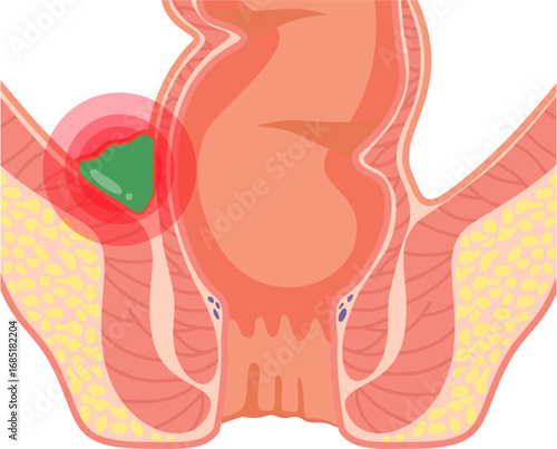 Supralevator Abscess