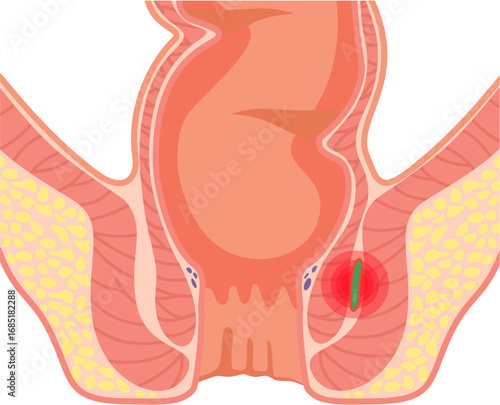 Submucous Abscess 