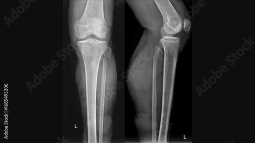 Fotografie X-ray of left leg showing fibula bone fracture – AP and lateral views