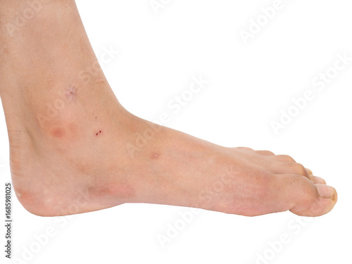 Skin on the feet and legs with scars and dark spots makes the skin unattractive, skincare concept.