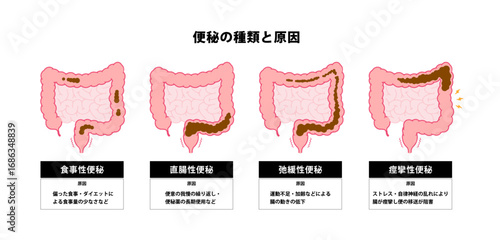 Types of constipation vector illustration