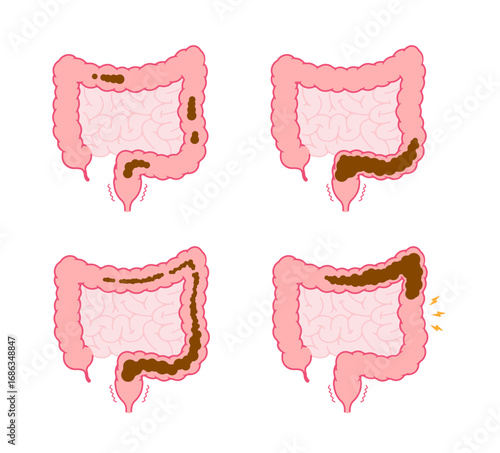 Types of constipation vector illustration
