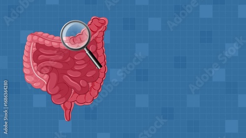 Endoscopic Polyp Removal Procedure in Large Intestine Animation