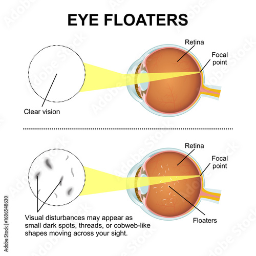 Eye Floaters flashcard medical eye illustration