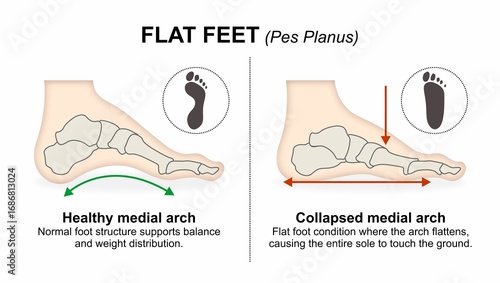 Flat Feet (Pes Planus) foot flashcard illustration