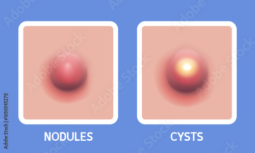 Nodular and cyst. Types of acne. Vector illustration