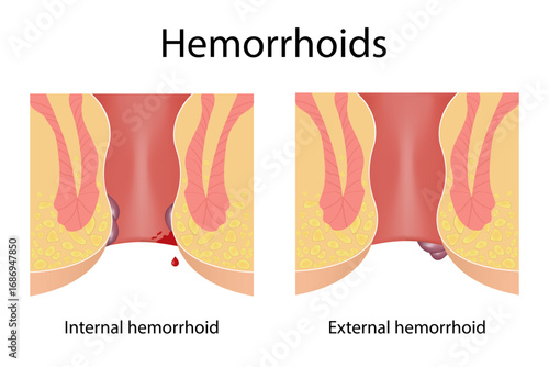 Two types of hemorrhoids. Internal and external. Medical illustration, treatment