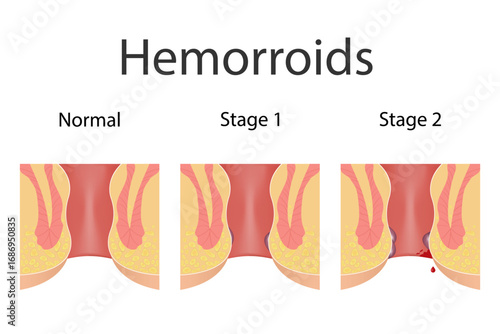 Hemorrhoids, stages of the disease, medical illustration, anatomy of the rectum. Proctology, treatment