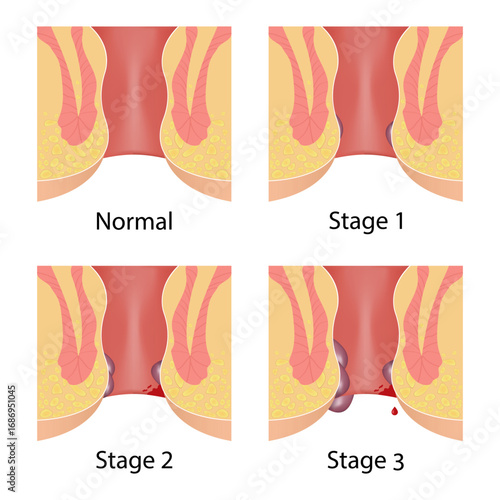 Hemorrhoids, stages of the disease, medical illustration, anatomy of the rectum. Proctology, treatment
