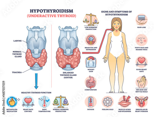Hypothyroidism is shown with a thyroid gland diagram, symptoms, and hormone imbalance. Key objects, thyroid gland, hormone icons, symptom chart. Outline diagram