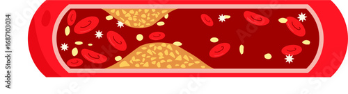 Atherosclerosis 